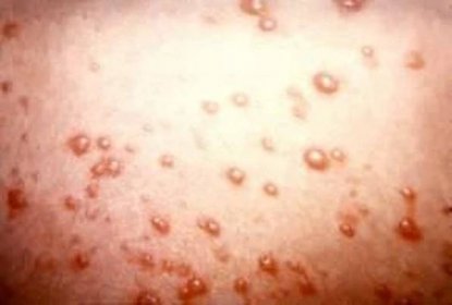 Příčiny a příznaky neštovic / Kuřecí neštovice
