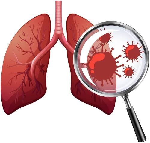 Lung Cancer - Anil Cancer Clinic