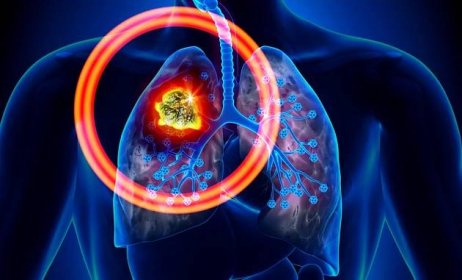 Sedm často přehlížených příznaků rakoviny plic. Zakročte včas, dokud není pozdě