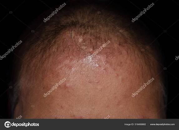 Malé Kožní Léze Čele Asijského Dítěte — Stock Fotografie © zaynyinyi #516499882
