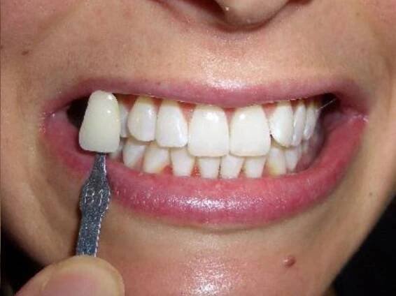 Teeth Whitening - Pont Street, London Dentist - Treatments