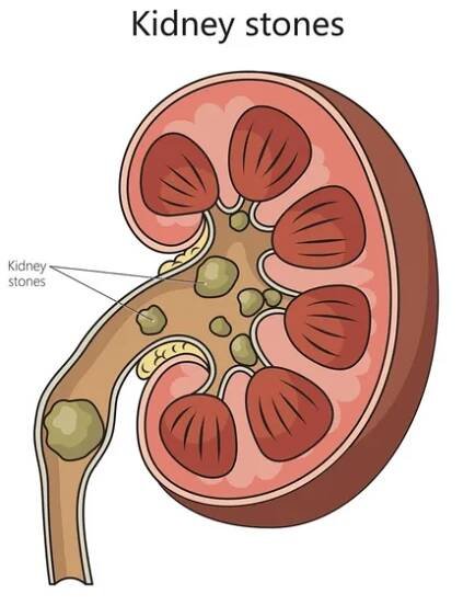 Diagram schematické rastrové ilustrace onemocnění ledvin. Vzdělávací ilustrace lékařské vědy — Stock obrázek