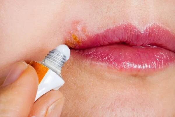 Herpes na rtu makrofotografie. Žena maže retní opar mast — Stock obrázek