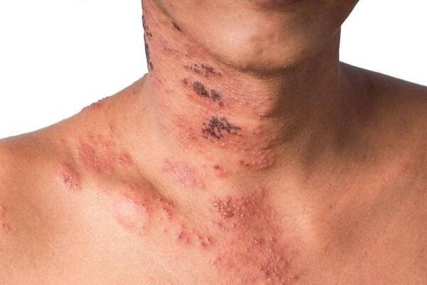 Herpes zoster nebo pásový opar nebo Zoster; příznak je infikován virem Varicella Zoster nebo VZV. je virové onemocnění charakterizované bolestivou kožní vyrážkou s puchýři v lokalizované oblasti. Vyrážka se vyskytuje v jedné části, široké svědění na boku těla — Stock obrázek