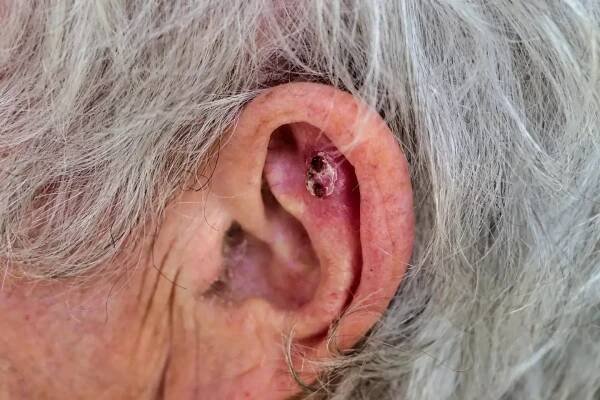 People are most likely to develop basal cell carcinoma on bits of skin often exposed to the sun (Getty Stock)