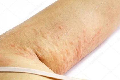Alergická vyrážka kůže pacienta ARM