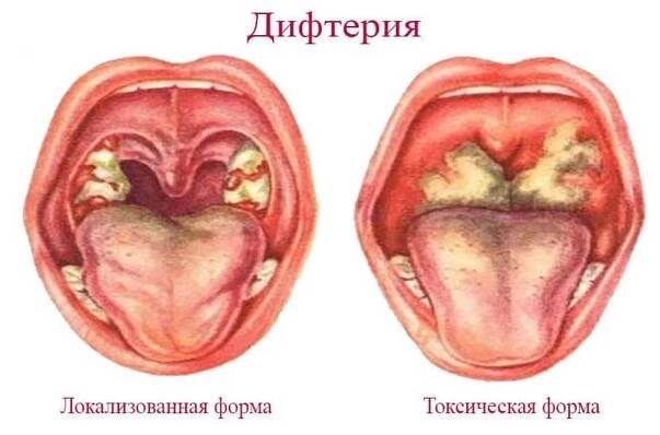 Příznaky a léčba záškrtu / Záškrt | Užitečné informace a tipy na péči o sebe. Zdraví, výživa a další.