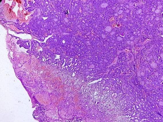 metastazující papilární karcinom štítné žlázy (rakovina), centrální lymfatická uzlina. - axillary lymph node - stock snímky, obrázky a fotky
