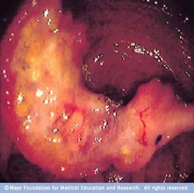 Colon cancer
