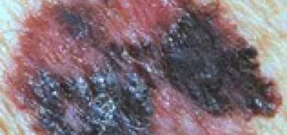 Nějak takto nebo podobně vypadá melanom - zhoubné onemocnění kůže