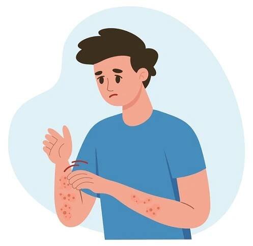 Muž se poškrábal na dlani. Alergické svědění, kožní zánět, zarudnutí a podráždění. Atopická dermatitida, ekzém, lupénka. Zdravotnictví a medicína. Stock vektor