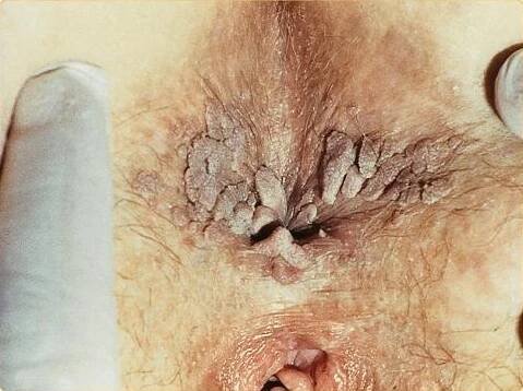 Soubor:SOA-Condylomata-acuminata-around-anus.jpg – Wikipedie