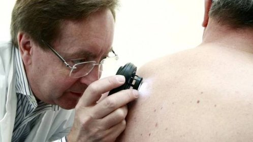 Češi podceňují prevenci melanomu - Novinky