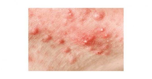 Nodulární cystická akné kůže — Stock obrázek
