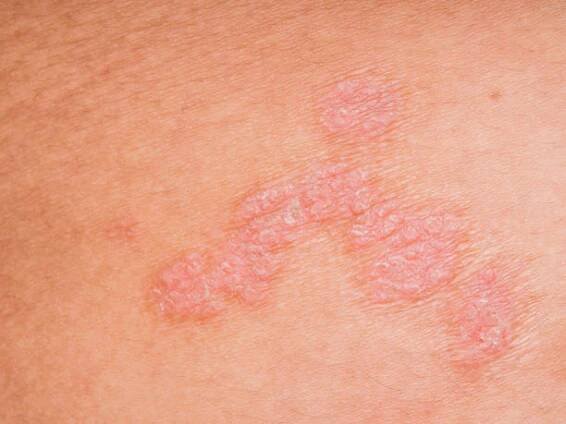 psoriáza kůže. - atopická dermatitis - stock snímky, obrázky a fotky