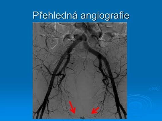 PPT - Může pomoci angiolog v diagnostice a léčbě erektilní dysfunkce ? PowerPoint Presentation - ID:4335542