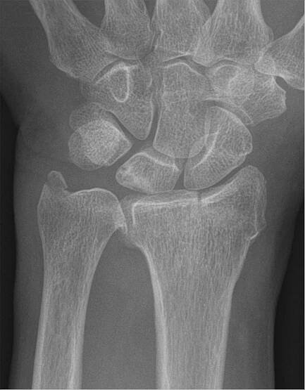Chauffeur's fracture
