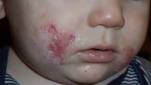 Kvasinková infekce u dětí: Příznaky, příčiny a léčba | Návod a tipy