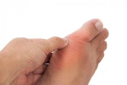 Bolestivé onemocnění dnou zánět na palec společné — Stock Fotografie © Thamkc #91638744