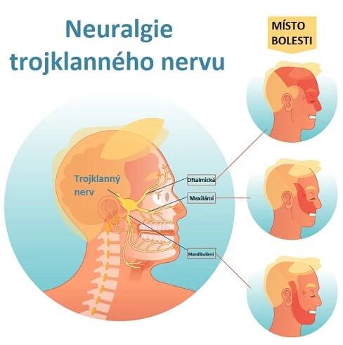 Trojklaný nerv a jeho 3 větve