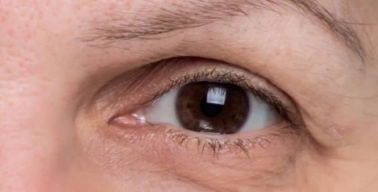 S přibývajícím věkem klesají oční víčka. Bojovat proti propadu pokožky můžete i bez chirurgických zákroků