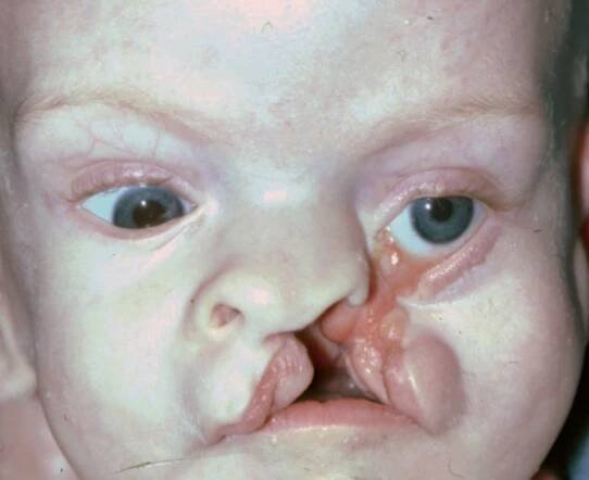 Craniofacial Clefts | Hellenic Craniofacial Center