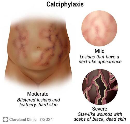 Do You Know What Calciphylaxis Is?