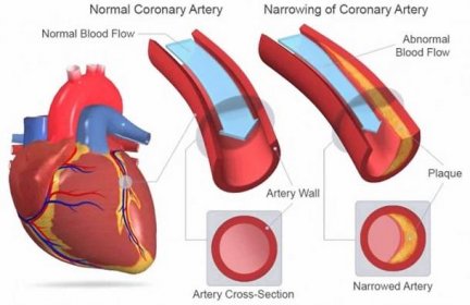 Coronary Artery Surgery - Newport Cardiac & Thoracic Surgery