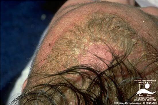 Dermatitis seborrhoica – Seboroická dermatitída – Dr Konrad Pharma