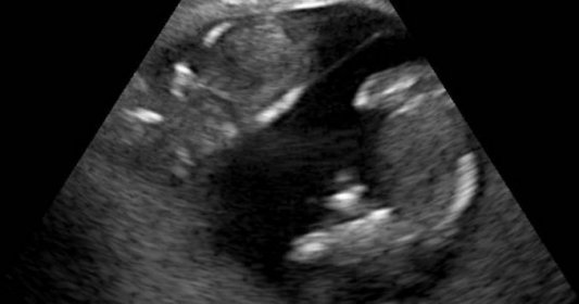 ultrazvuk-snimek-tehotenstvi