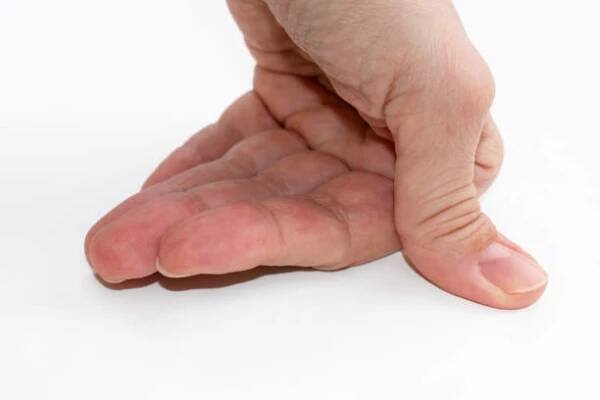 kloubní hypermobilita - ruka s hypermobilním palcem zblízka - marfanův syndrom - stock snímky, obrázky a fotky