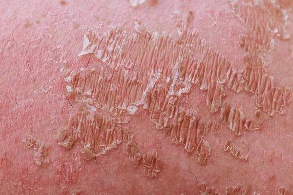 Správa psoriatický ekzém vyžaduje specializované znalosti v oblasti dermatologie. — Stock obrázek