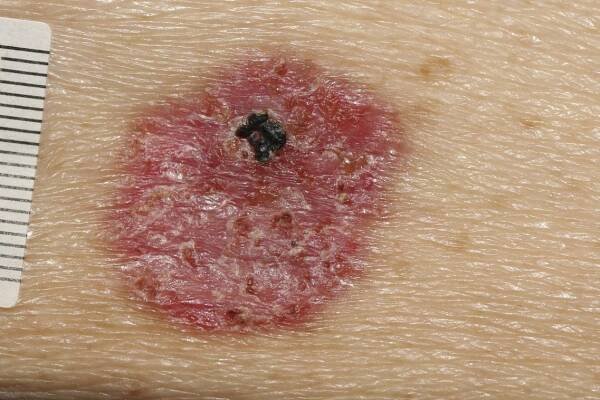 909 Archives - Skin Cancer 909