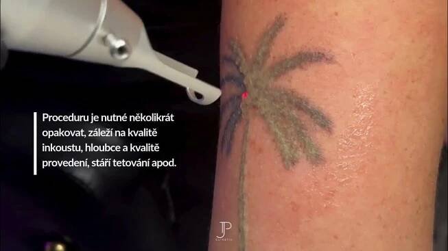 Odstranění tetování BRNO www.jpesthetic.cz tattoo removal