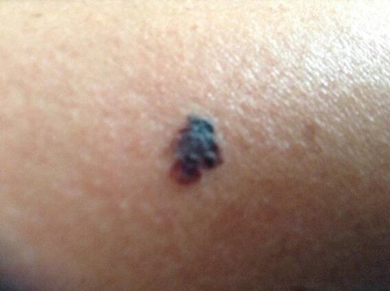 Melanoma (ICD-10: С43) - Online consultation AI dermatologist