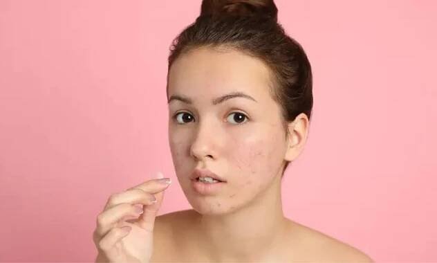 How to Remove Pimple Marks Naturally At Home