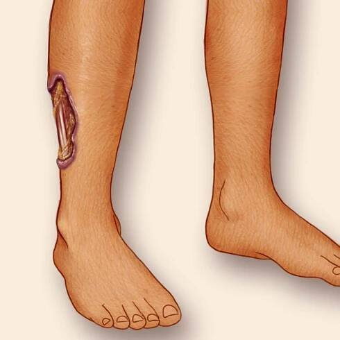 Pyoderma Gangrenosum Illustrations for BIPOC Skin Tones