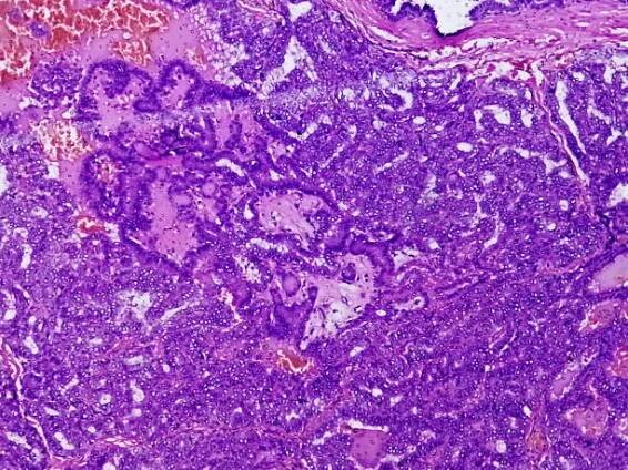 metastazující papilární karcinom štítné žlázy (rakovina), centrální lymfatická uzlina. - axillary lymph node - stock snímky, obrázky a fotky