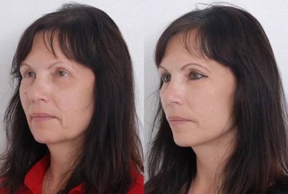 Facelifting Quick Lift - foto před a po