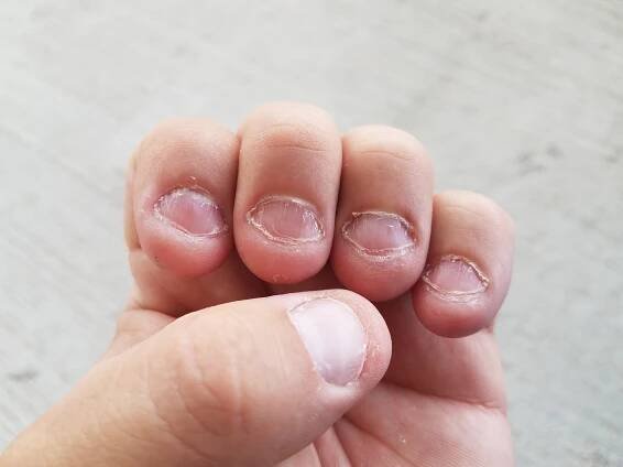 Disgusting,Bitten,Fingernails,On,Man's,Hand