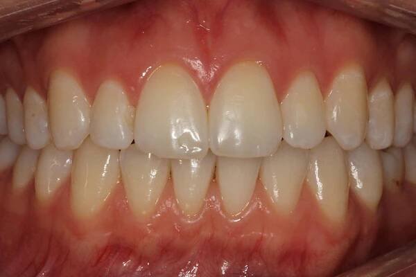 Before and After • 425 Dental
