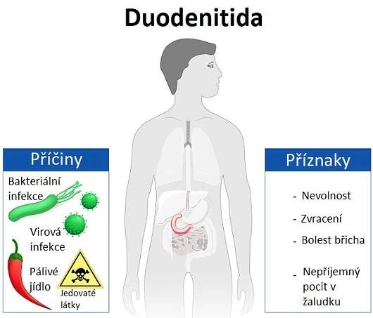 Duodenitida neboli zánět dvanáctníku - ilustrace
