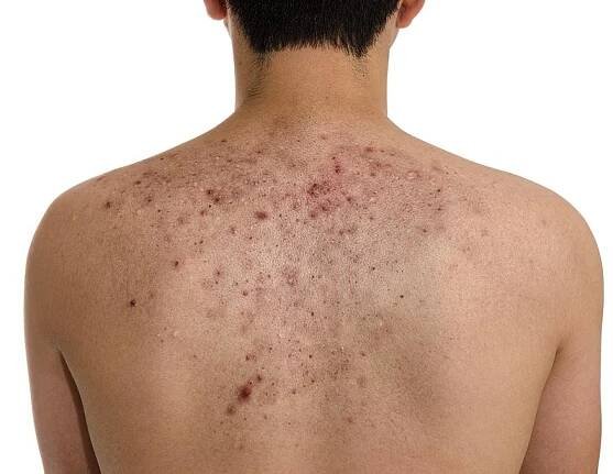 Příčiny akné a zánětu akné a metody léčby / Dermatologie