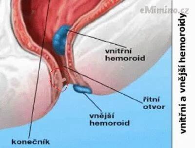 1168603747_hemoroidy.gif