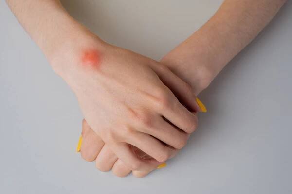 Lipoma Treatment