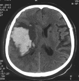 Cerebrovascular Disease | Neurosurgeon