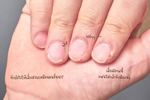 อาหารบำรุงเล็บสวย จบปัญหา เล็บ บางฉีกง่าย