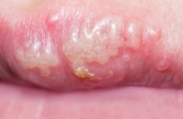 herpes, opar