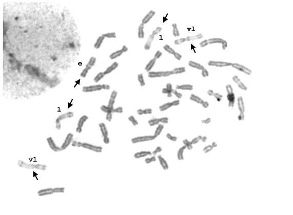Detailed analysis of X chromosome inactivation in a 49,XXXXX pentasomy