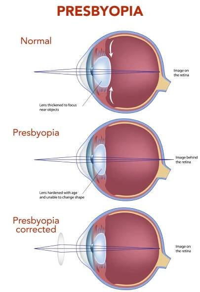 Laser Blended Vision - Saint James Eye Clinic